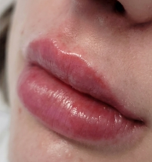 Lip Lines After
