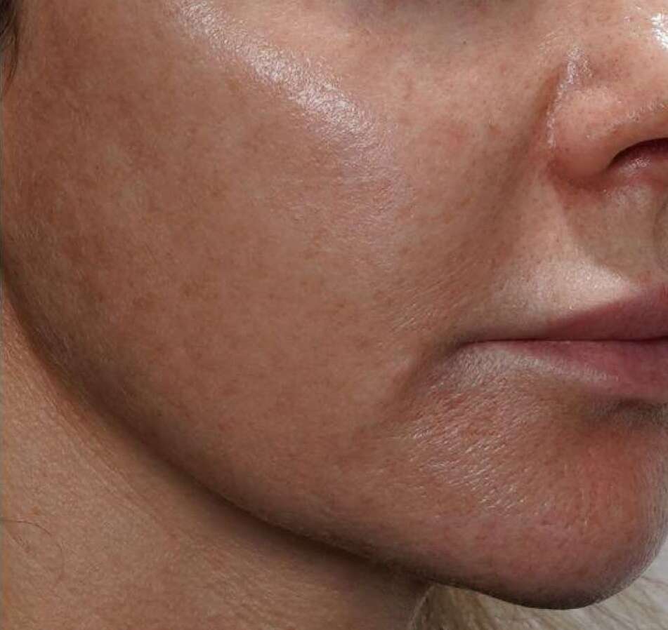 Pigmentation After
