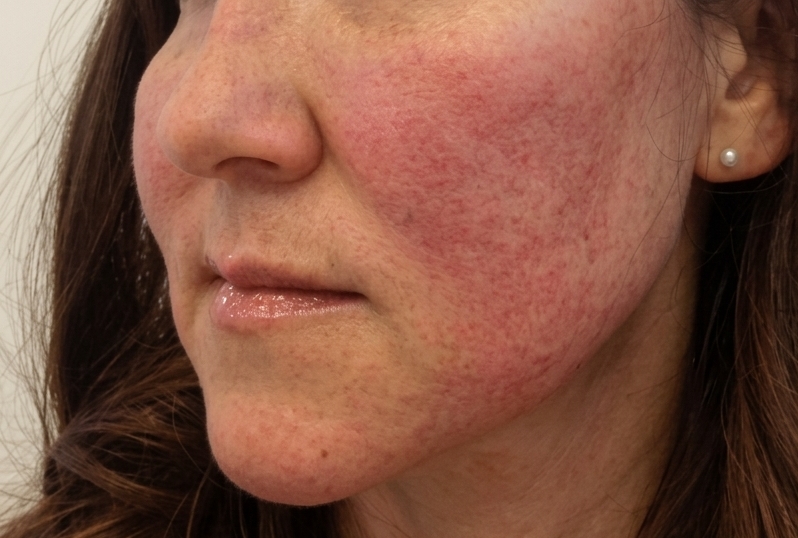 Rosacea Before