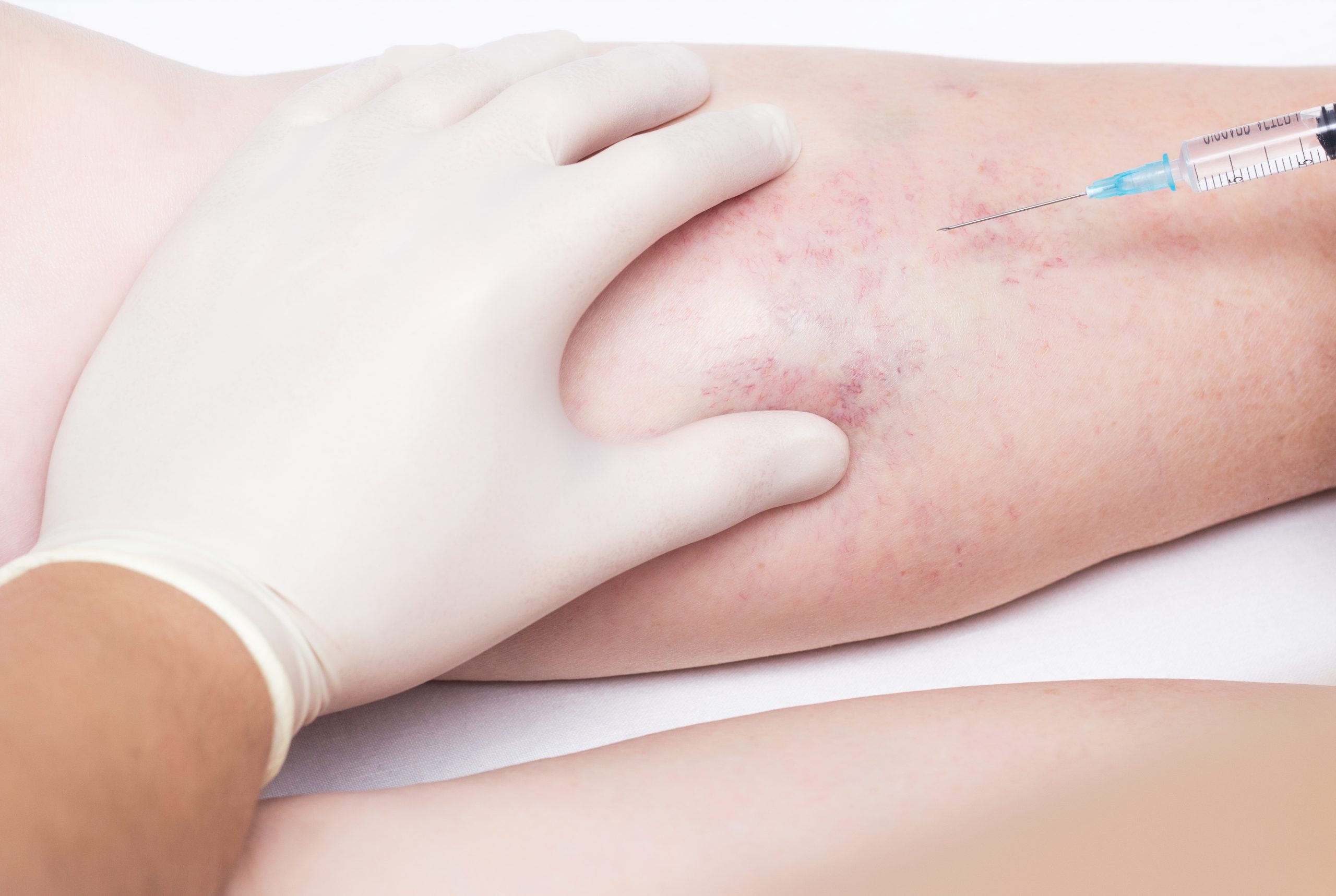 Microsclerotherapy Procedure Expectations