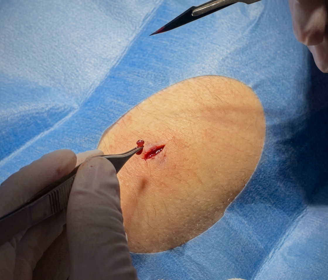 Varicose Vein Surgery