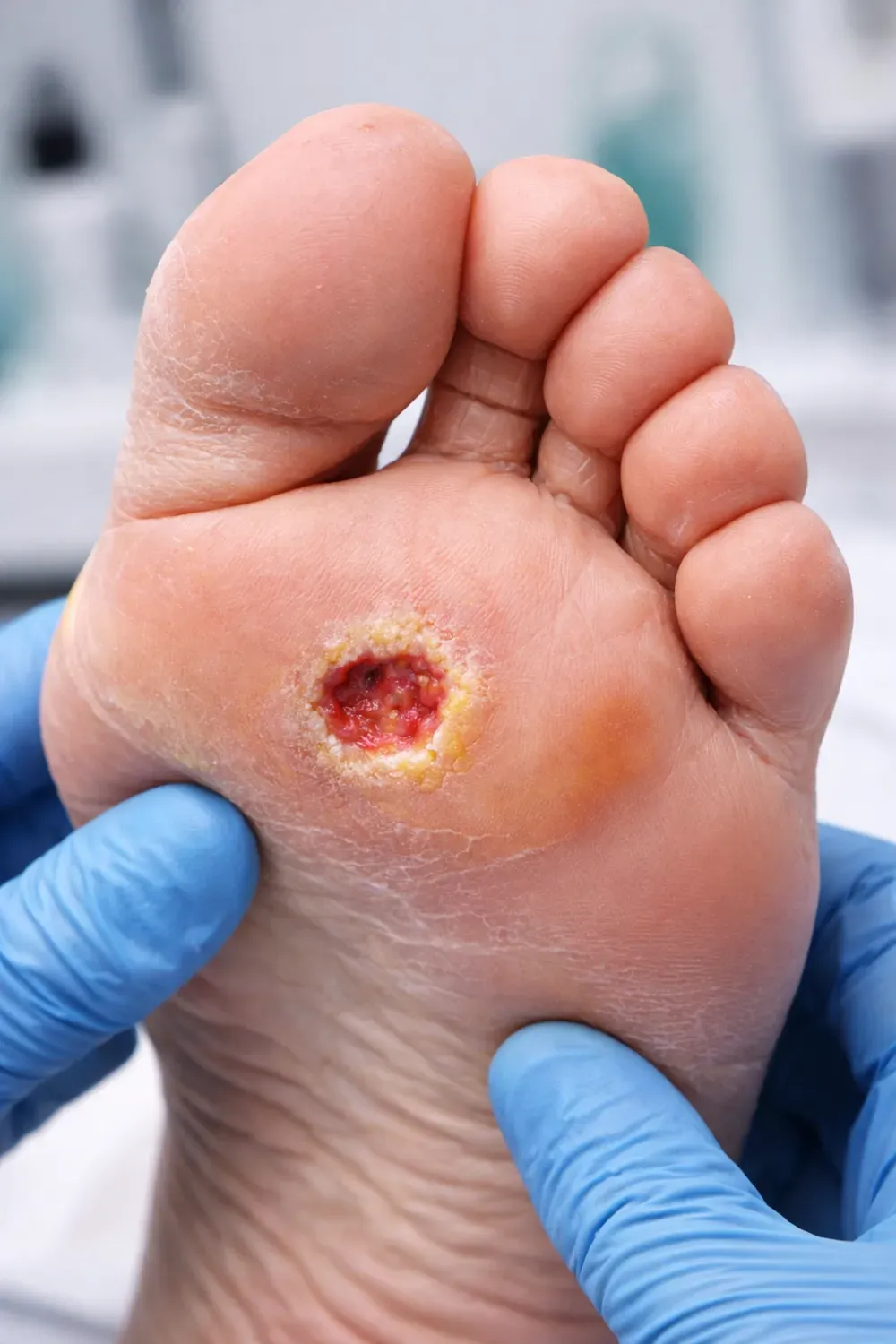 Diabetic Foot Ulcers