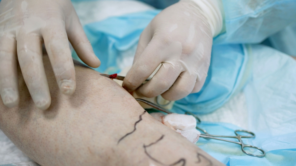 Varicose Vein Surgery