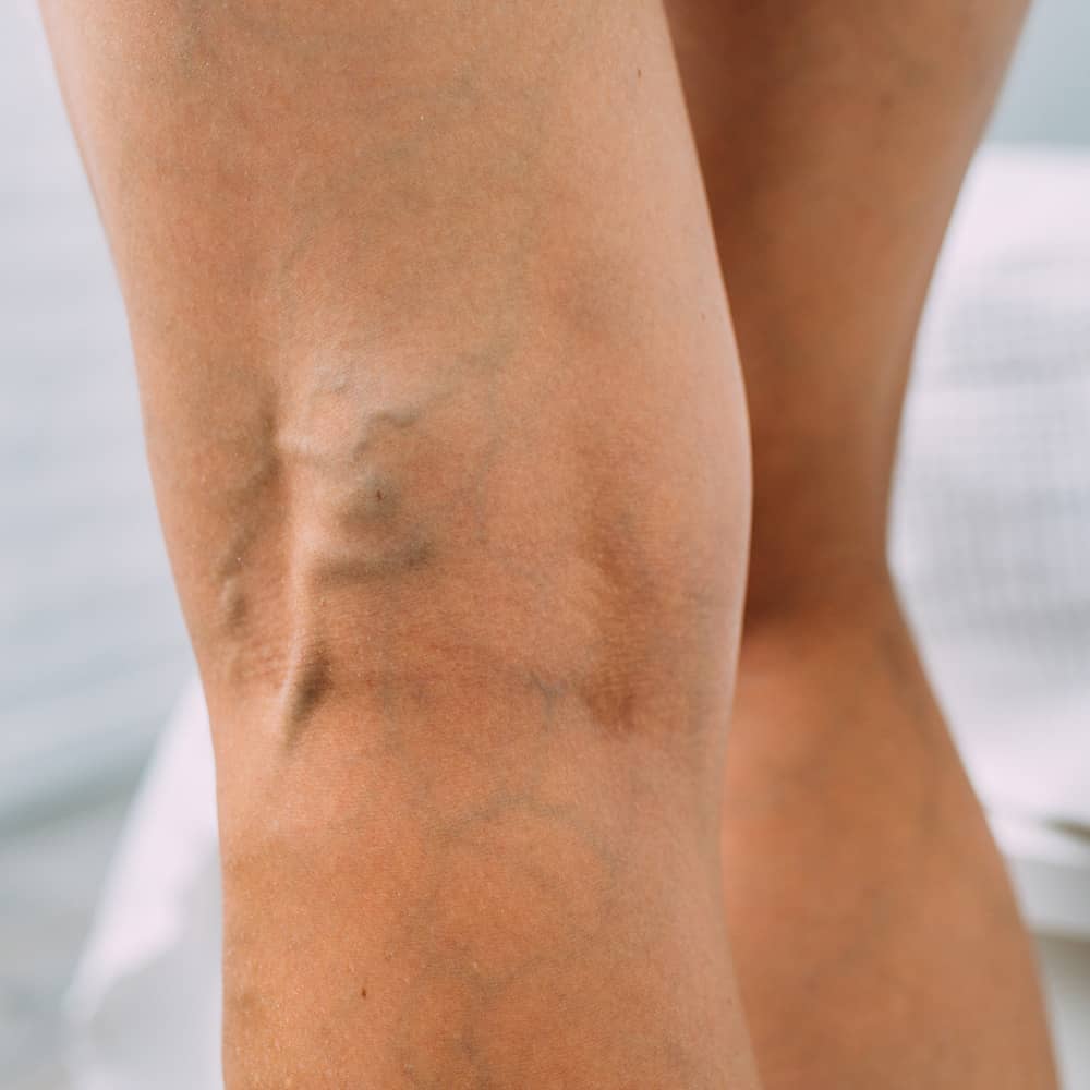 Varicose Vein Symptoms